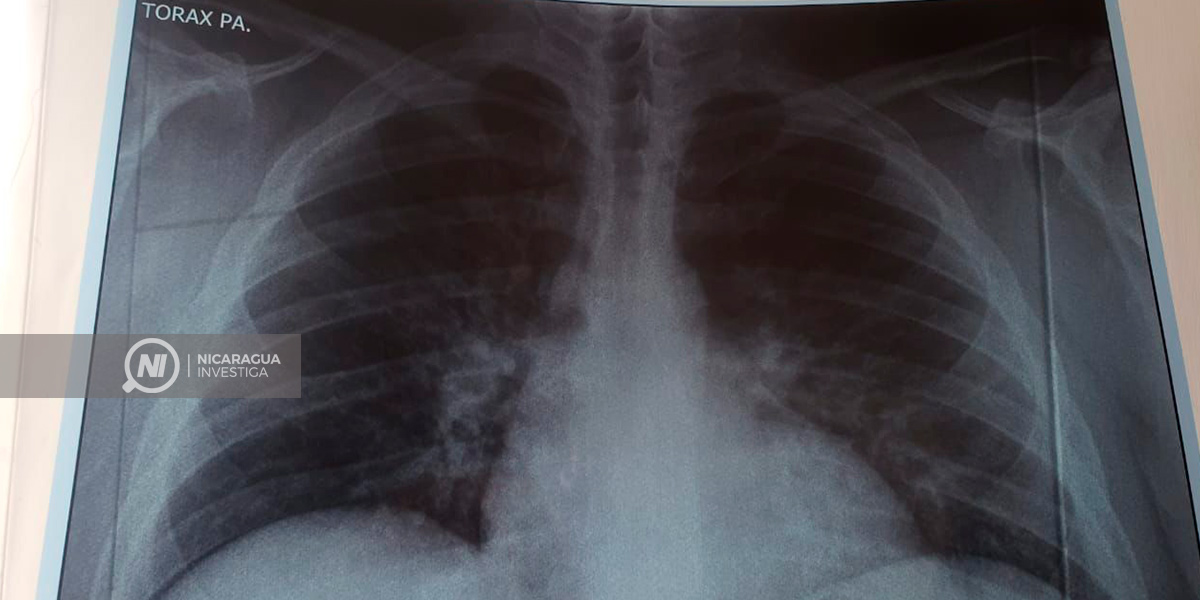 Asperguillus pulmonar, la nueva complicación de COVID-19
